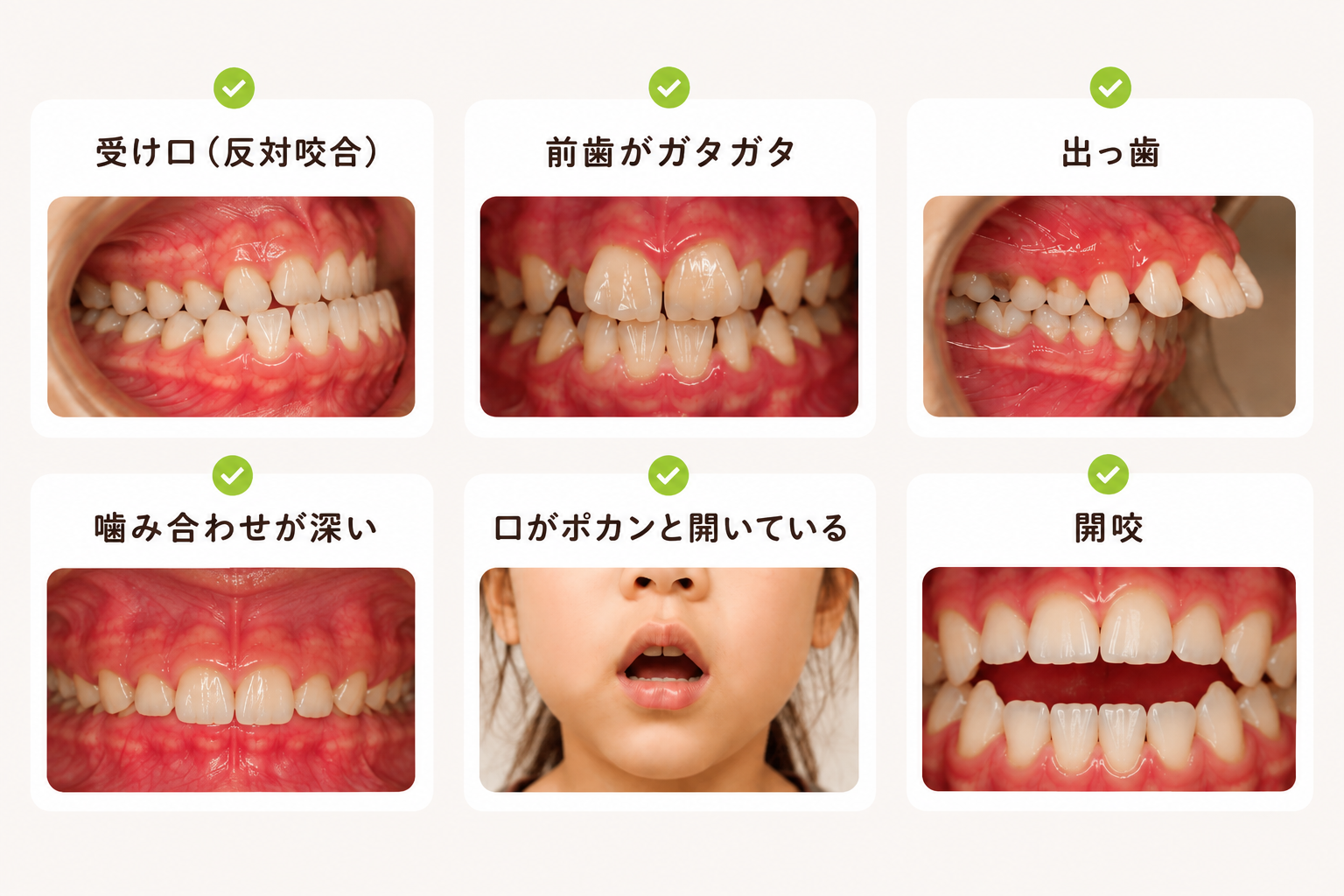 お子さまの歯並び・小児矯正の外観